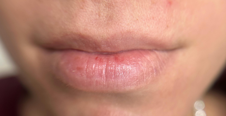 Lip Blush, prima del trattamento